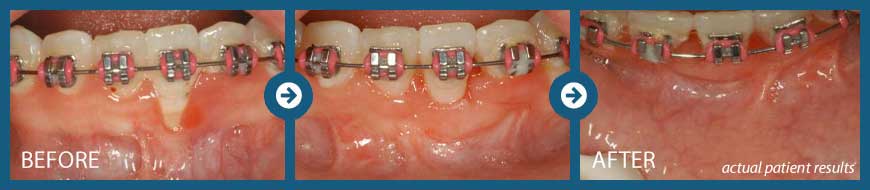 Gum Graft Memphis Soft Tissue Grafting Periodontal Associates Of Memphis