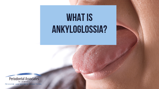 What is Ankyloglossia?