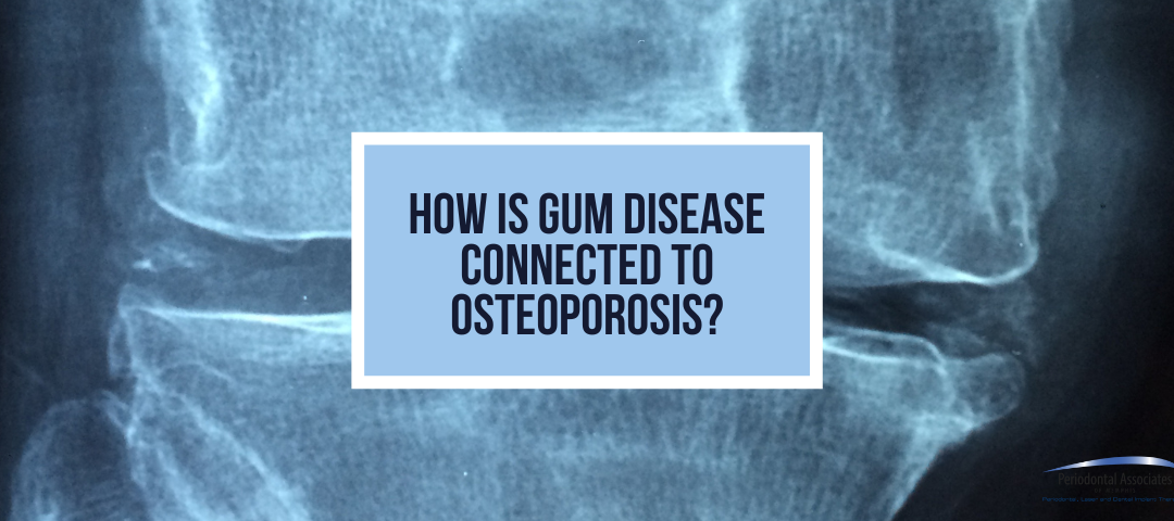 How is Gum Disease Connected to Osteoporosis?